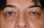 Female Eyelid Surgery