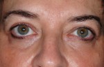 Female Eyelid Surgery