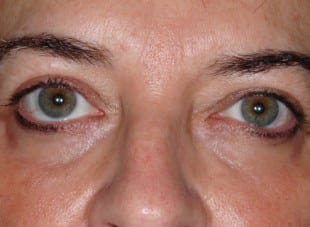 Patient 170 - After View 