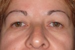 Female Eyelid Surgery