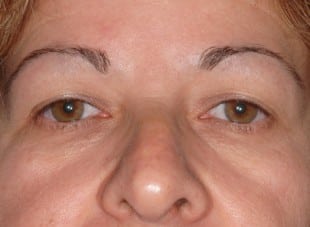 Patient 171 - Before View 