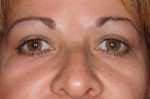 Female Eyelid Surgery