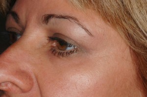 Female Eyelid Surgery