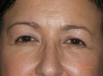 Female Eyelid Surgery