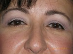 Female Eyelid Surgery