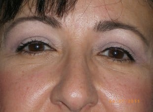 Patient 172 - After View 