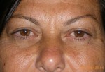 Female Eyelid Surgery