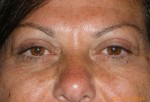 Female Eyelid Surgery