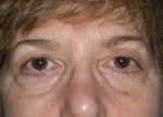 Female Eyelid Surgery