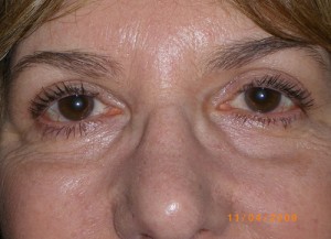 Female Eyelid Surgery