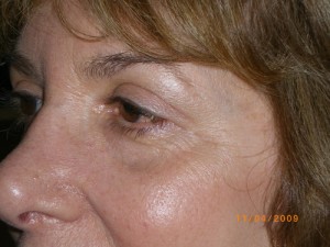 Female Eyelid Surgery