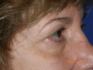 Female Eyelid Surgery