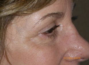 Patient 174 - After View 