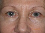 Female Eyelid Surgery