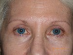 Female Eyelid Surgery