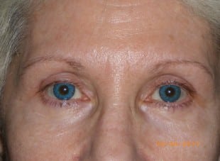 Patient 175 - After View 