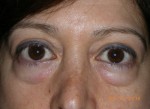 Female Eyelid Surgery