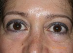 Female Eyelid Surgery