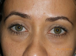 Female Eyelid Surgery