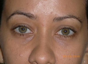 Female Eyelid Surgery