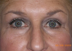 Female Eyelid Surgery