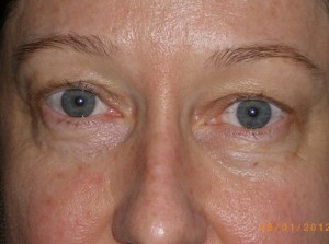 Female Eyelid Surgery