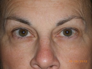 Female Eyelid Surgery