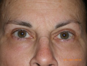 Female Eyelid Surgery