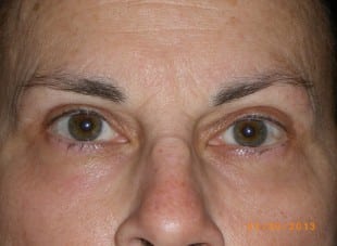 Patient 180 - After View 