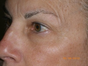 Female Eyelid Surgery