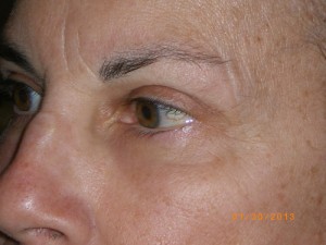 Female Eyelid Surgery