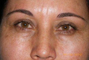 Female Eyelid Surgery