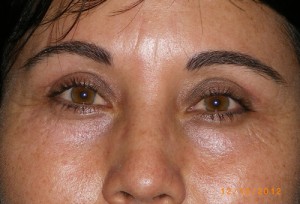 Female Eyelid Surgery