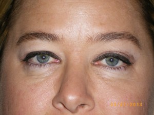 Female Eyelid Surgery