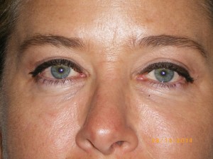 Female Eyelid Surgery