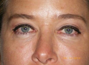 Patient 182 - After View 