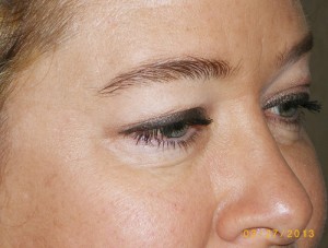 Female Eyelid Surgery