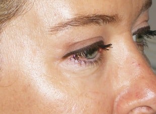 Patient 182 - After View 