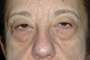 Female Eyelid Surgery