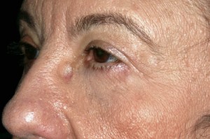 Female Eyelid Surgery