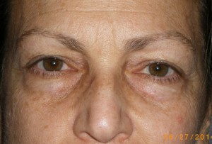 Female Eyelid Surgery