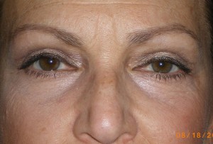 Female Eyelid Surgery