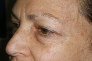 Female Eyelid Surgery