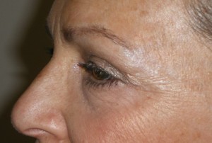 Female Eyelid Surgery