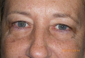 Female Eyelid Surgery