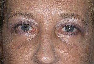 Female Eyelid Surgery