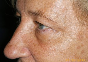 Female Eyelid Surgery