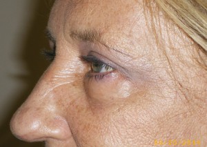 Female Eyelid Surgery