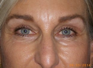 Patient 186 - After View 