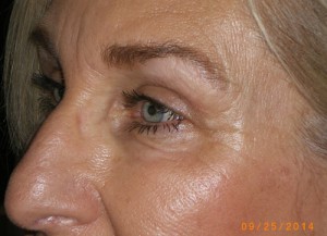 Female Eyelid Surgery